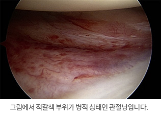 사진:그림에서 적갈색 부위가 병적 상태인 관절낭입니다.