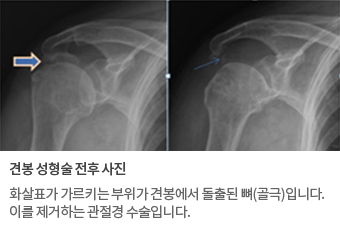 사진:견봉 성형술 전후 사진. 화살표가 가르키는 부위가 견봉에서 돌출된 뼈(골극)입니다.이를 제거하는 관절경 수술입니다.