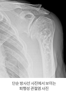 단순 방사선 사진에서 보이는 퇴행성 관절염 사진