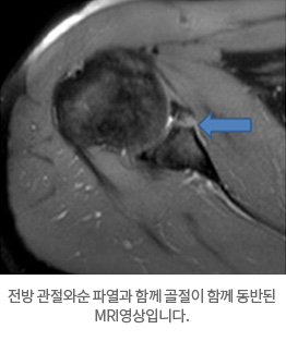 전방 관절와순 파열과 함께 골절이 함께 동반된 MRI영상입니다.