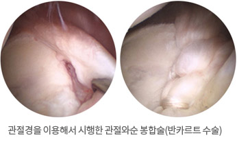 관절경을 이용해서 시행한 관절와순 봉합술(반카르트 수술)