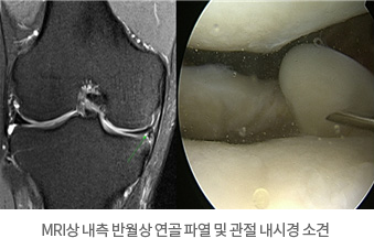 MRI상 내측 반월상 연골 파열 및 관절 내시경 소견