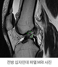 전방 십자인대 파열 MRI 사진