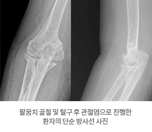 팔꿈치 골절 및 탈구 후 관절염으로 진행한 환자의 단순 방사선 사진