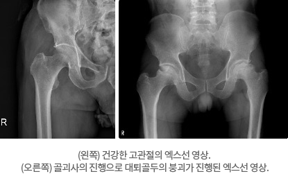 (왼쪽) 건강한 고관절의 엑스선 영상. (오른쪽) 골괴사의 진행으로 대퇴골두의 붕괴가 진행된 엑스선 영상.